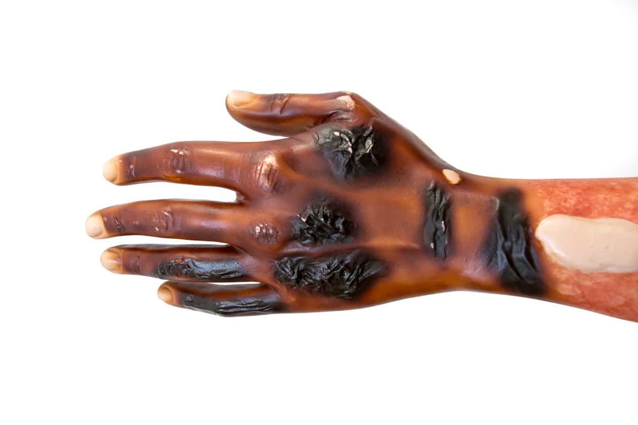 Abogados Especializados En Casos De Lesiones Por Quemaduras En Bakersfield